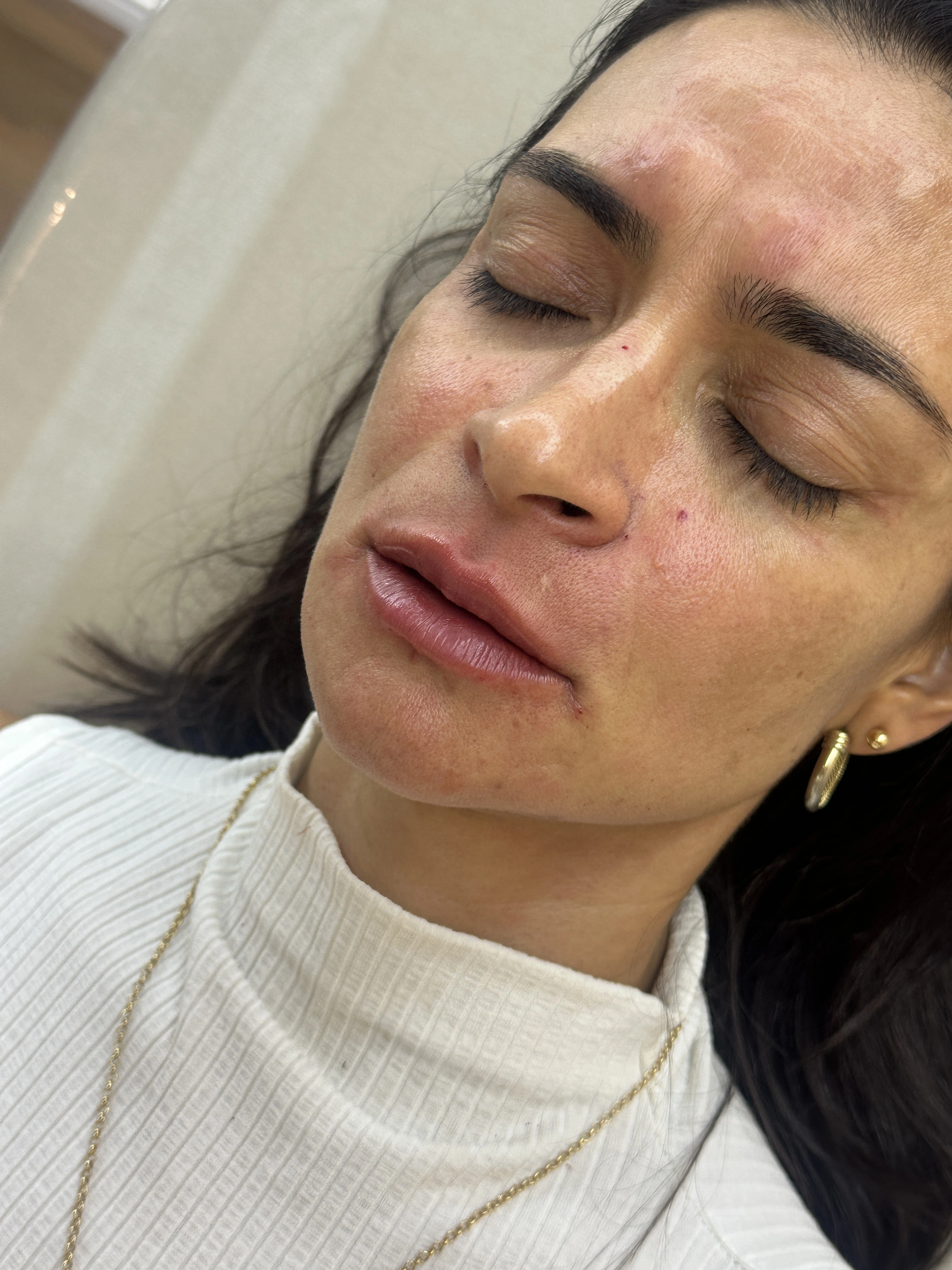 Paciente depois do procedimento