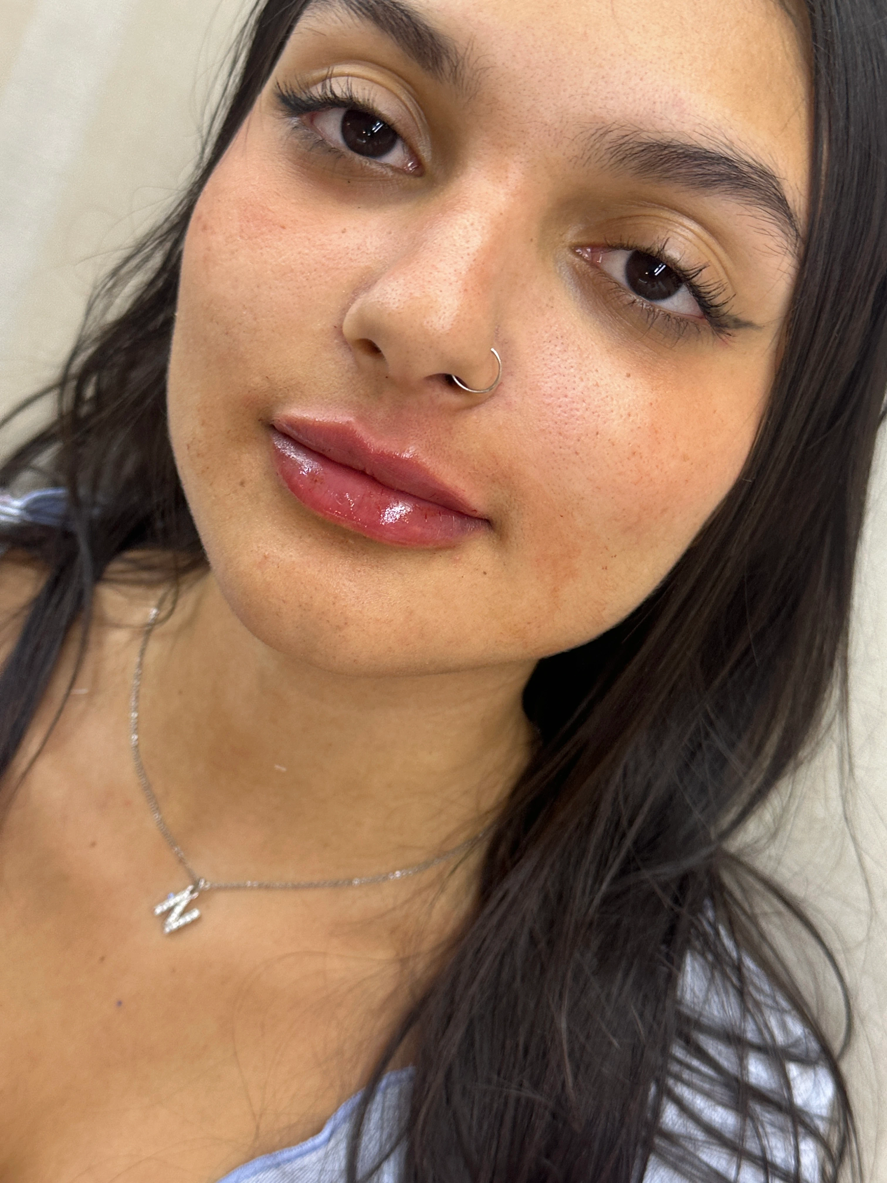 Paciente depois do procedimento